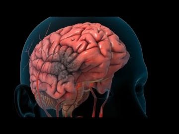 Stroke | Nucleus Health