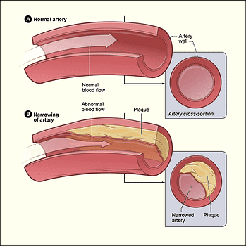 Source: National Heart, Lung, and Blood Institute; National Institutes of Health; U.S. Department of Health and Human Services.