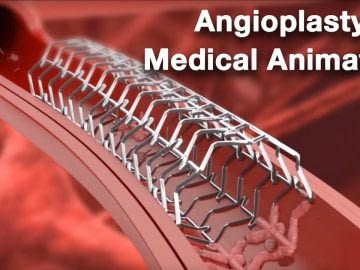Angioplasty - Medical animation